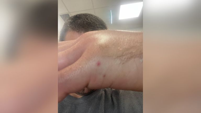 The hiker&#39;s swollen hand after being bitten by the broad-headed snake